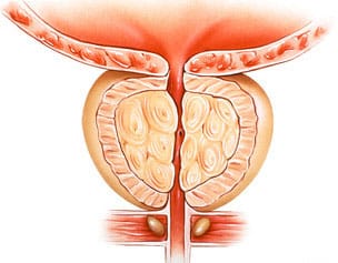 Prostate Treatment